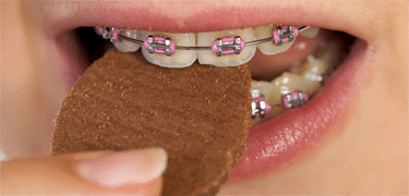 Close up of a mouth with braces eating a cookie.