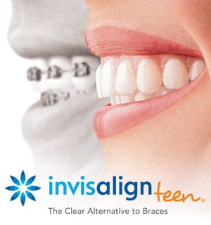invisalign for teens, an alternative to braces treatment