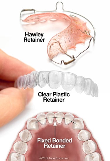 the three different types of orthodontic retainers, bonded, hawley, and aligners