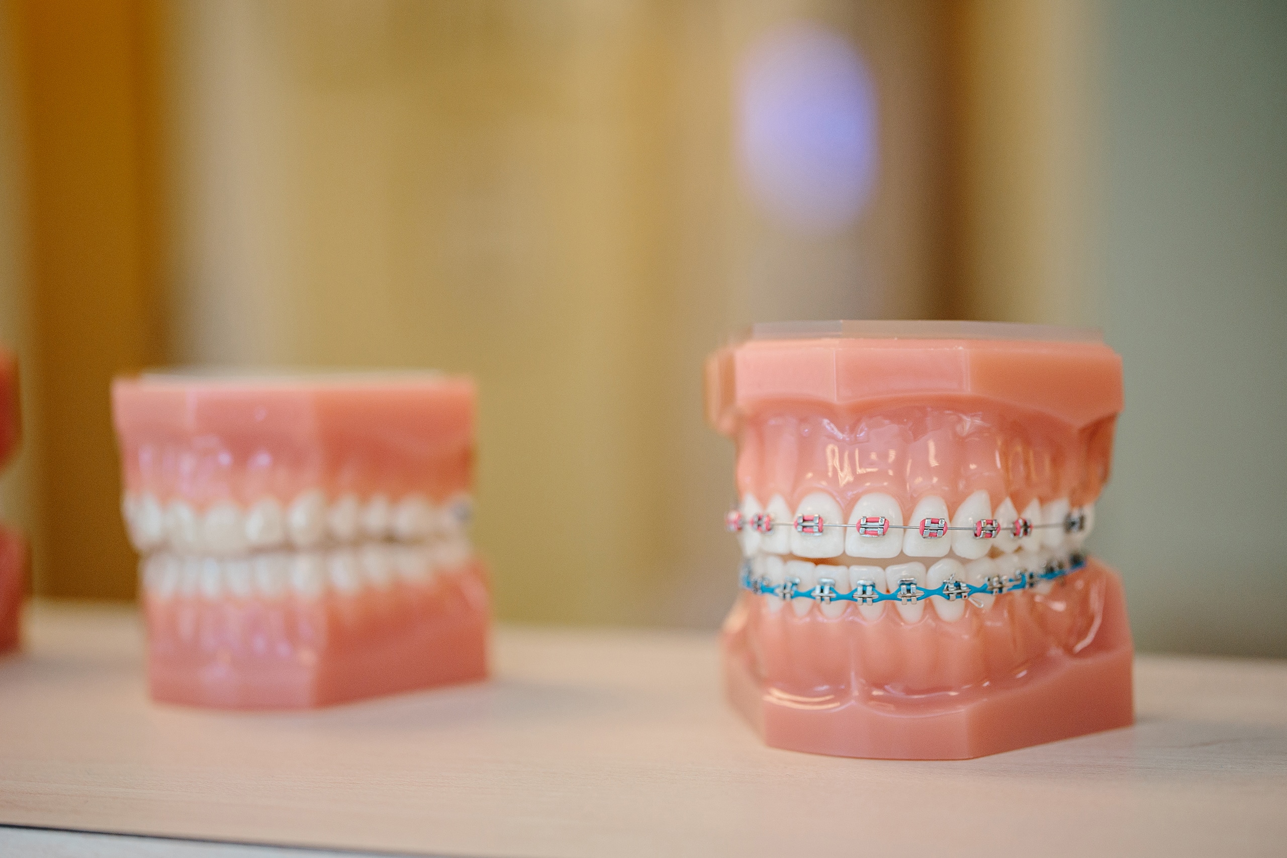 A set of plastic teeth models with metal and clear braces.