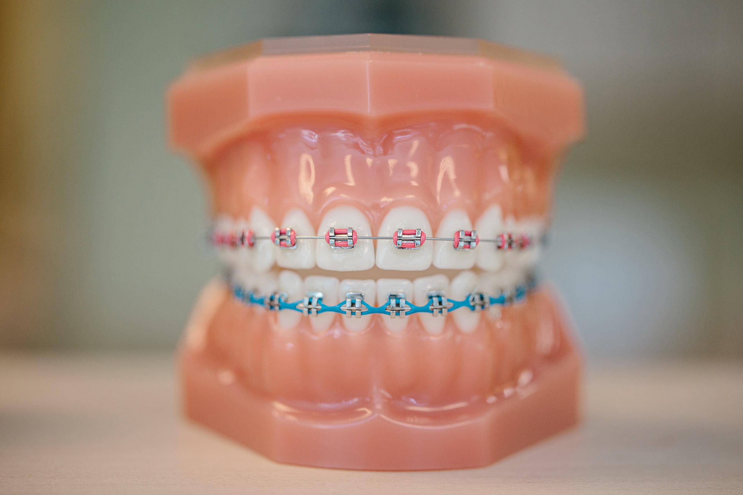 Plastic model of teeth with metal braces and pink and blue elastic bands.