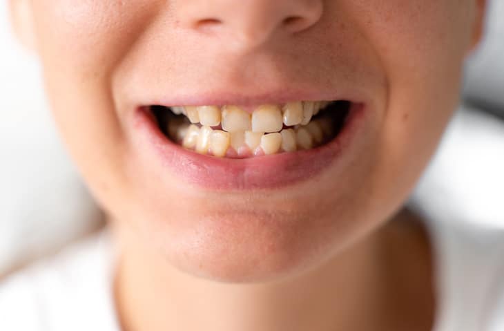 a close up of a child's crooked teeth