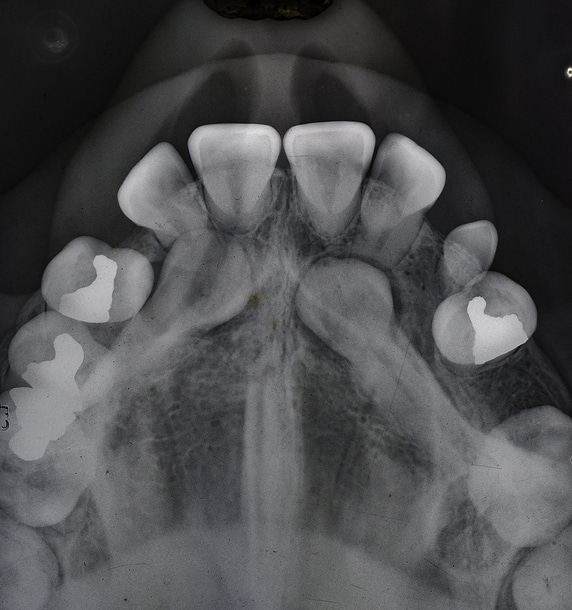 the x ray images of an orthodontic patients mouth