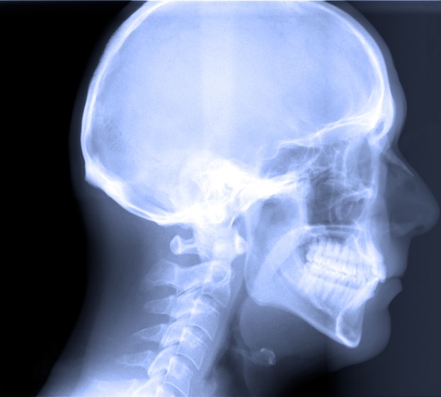 a side view x ray image of a patient's mouth