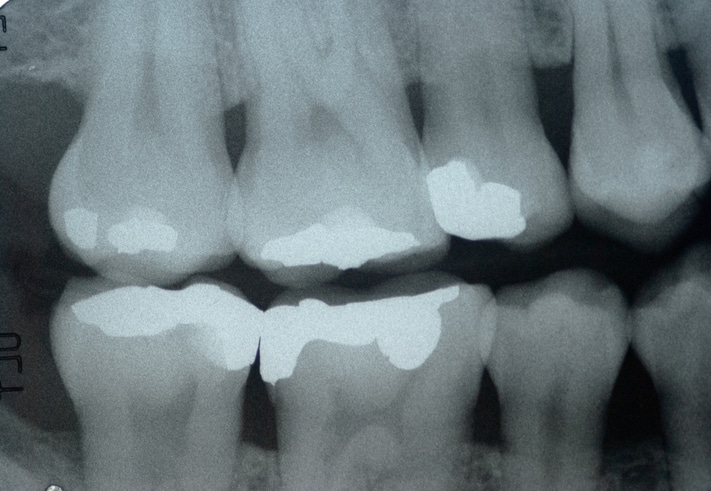 dental x rays of teeth with cavities
