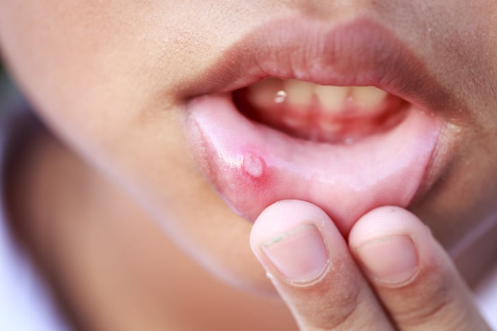 an upclose image of a person's lip with a canker sore