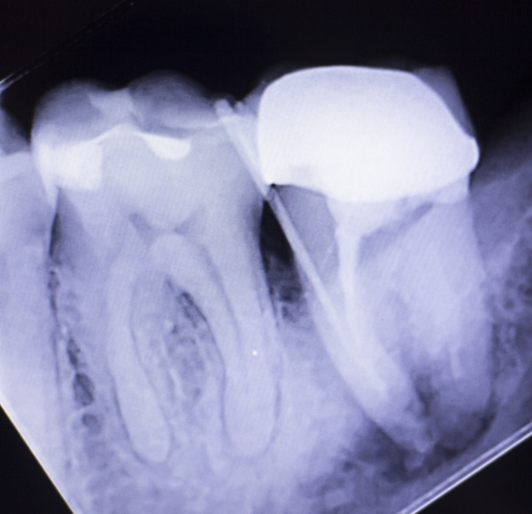 zoomed in xray of a tooth with crown root canal treatment