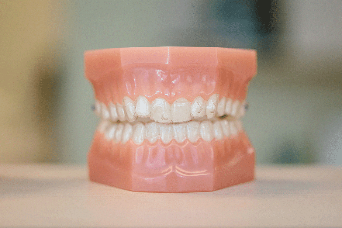 a typodont model with clear aligners