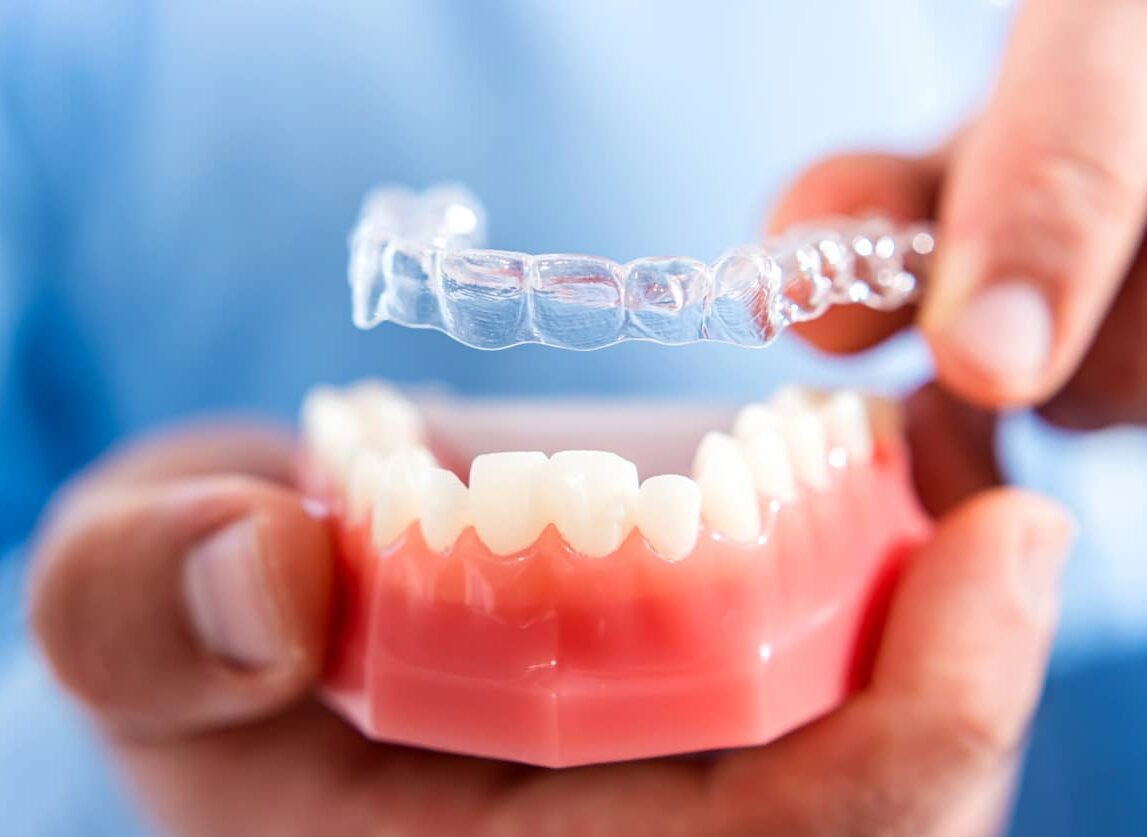 Braces, Spark Aligners, and More: Orthodontic Treatment Options in Falls  Church - Merrifield Orthodontics