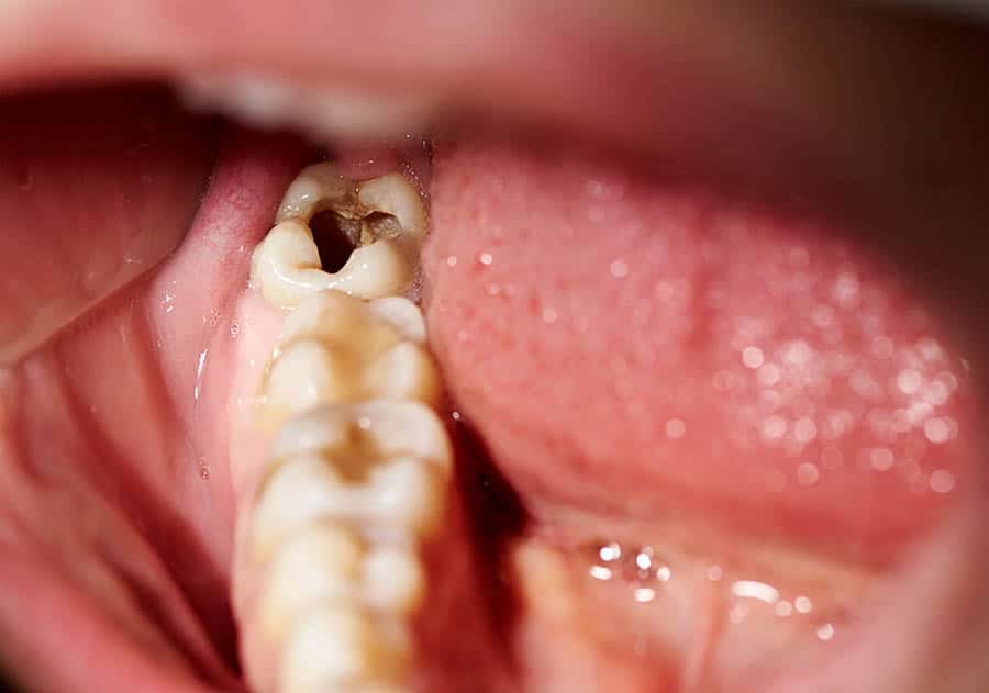 close up view of tooth decay which is a common problem