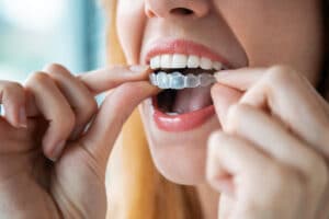 a woman puts in an invisalign retainer