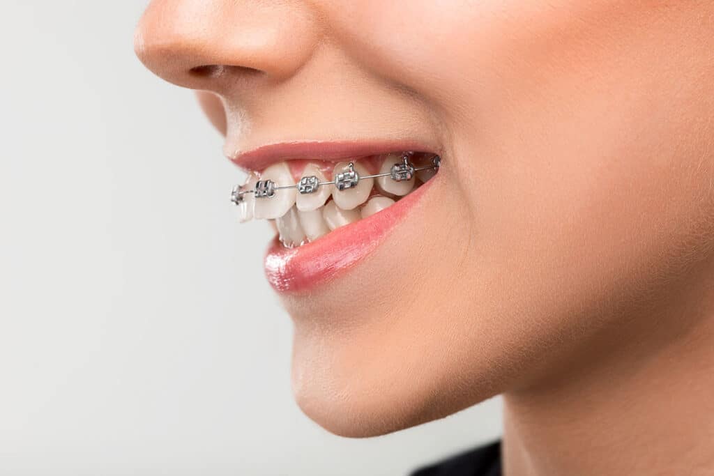 a child gets braces to correct an overbite