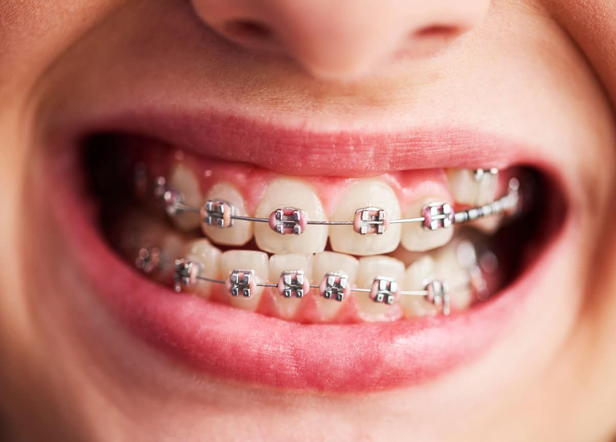 a teen shows off her clean braces