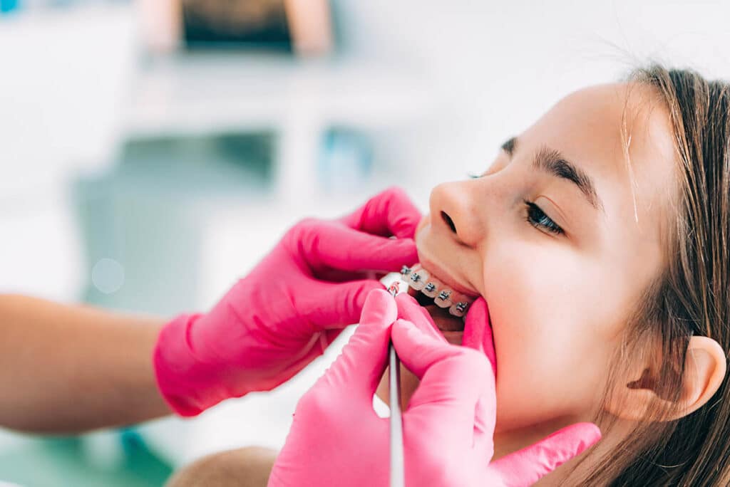 a kid has braces put on at the orthodontist